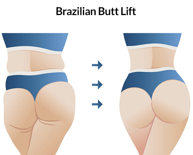 Butt lift /volume with Optional Cellulite Reduction at The Glamour Loft (Up to 58% Off)